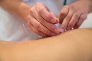 Beehive Healthcare Chester | Health and Wellbeing | Acupuncture