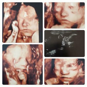 Beehive Healthcare Chester | Ante and Postnatal Pregnancy Care and Wellbeing | 4D Baby ultrasound scan